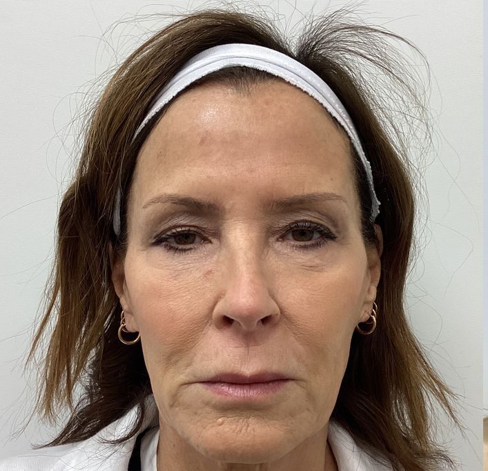 Dermal-Fillers - 5c4ffe14-5299-490a-bd3d-3c4ba7f1aaf0