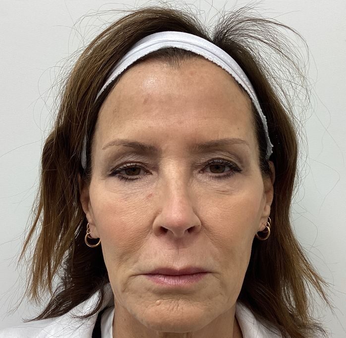 Dermal-Fillers - 5c4ffe14-5299-490a-bd3d-3c4ba7f1aaf0